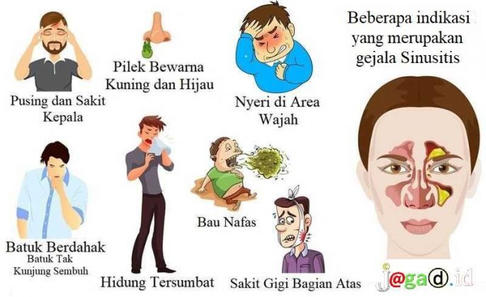 Sinusitis : Bahaya, Pengobatan, Pencegahan, Sinusitis Akut - JAGAD ID