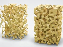 Pengertian Osteoporosis Adalah Penyakit Definisi Gambar Contoh Gejala, Penyebab, Faktor Resiko, Diagnosis dan Pengobatan